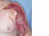 limb-debridement-following-on-from-mephedrone-injecting